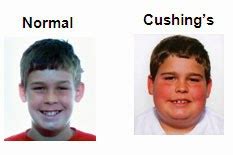 Cushing's Syndrome : Signs and symptoms of Cushing's syndrome