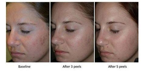 Glycolic Acid Peel: For Treatment Of Acne Scars | Wrytin