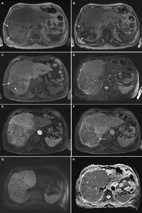 A 68-year-old male with recent diagnosis of HCC. Notes: HCC. (A ...