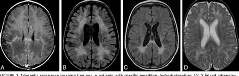 Leukodystrophies: Classification, Diagnosis, and Treatment | Semantic Scholar