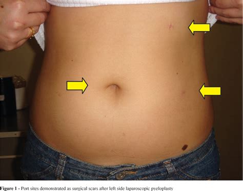 Robotic Laparoscopic Pyeloplasty - UroBriz