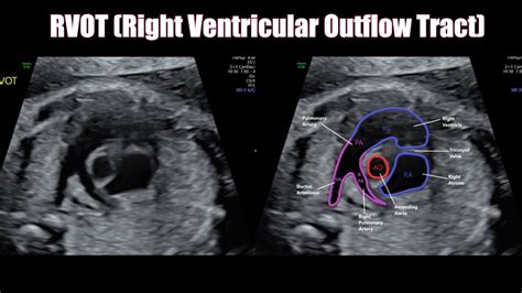 Fetal Heart Survey – Sonographic Tendencies