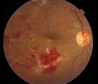 Cystoid Macular Oedema: Causes, Symptoms and Treatment | Neoretina