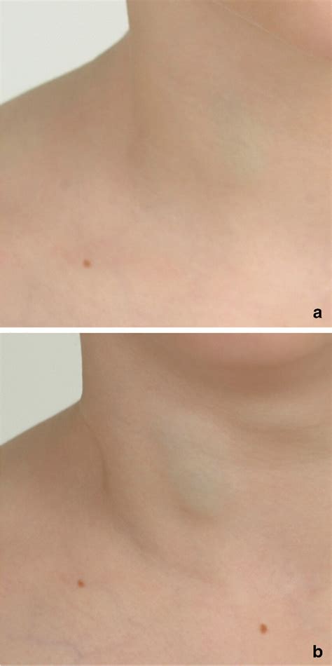 Venous malformation. a, b Clinical image shows a small blue... | Download Scientific Diagram