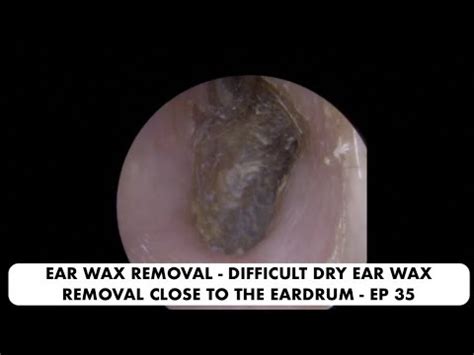 EAR WAX REMOVAL - DIFFICULT DRY EAR WAX REMOVAL CLOSE TO THE EARDRUM - EP 35 - YouTube