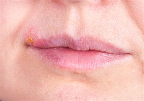 Las 5 etapas de un herpes labial que debes conocer - El Diario NY