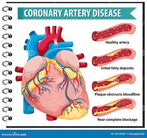 Coronary Artery Disease for Health Education Infographic Stock Vector ...