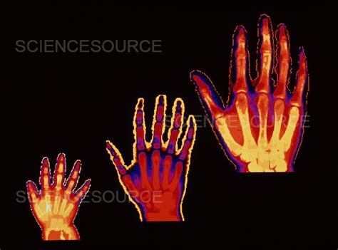 Photograph | Bone growth at 2, 6, 19 years | Science Source Images