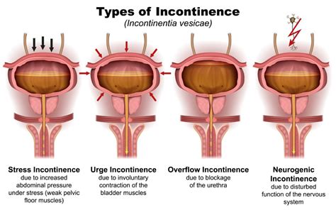 Causes & Types of Stress Urinary Incontinence – Chicago Urogynecology