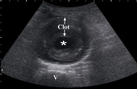 Ruptured Abdominal Aortic Aneurysm Ultrasound