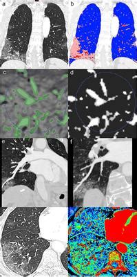 Frontiers | Case Report: Intrapulmonary Arteriovenous Anastomoses in COVID-19-Related Pulmonary ...