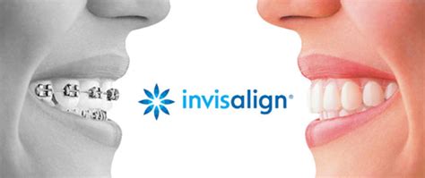 Invisalign in Collierville clear braces | Thames Family Dentist