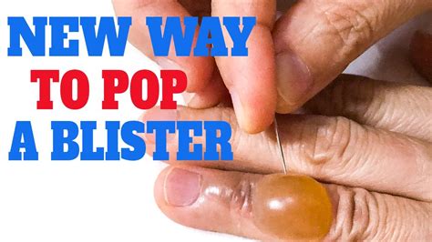 Pop goes the water blister | Pop a burn blister or not | Not pop a ...