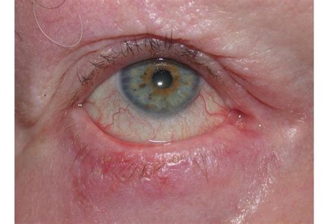 Eyelid Skin Cancer - mivision