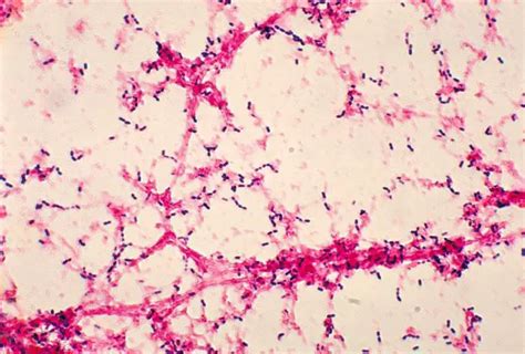 Streptococcus pneumoniae (pneumococcus): Disease, Properties ...