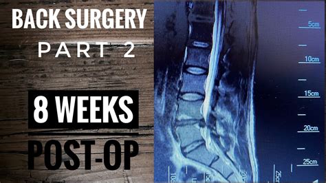 Back Surgery |L4-L5 Laminectomy| Recovery part 2 - YouTube