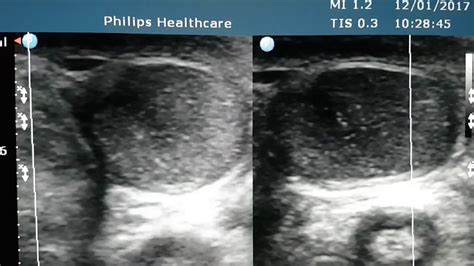 Testicular Microlithiasis Ultrasound - YouTube