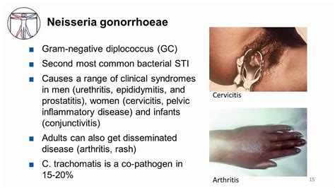 Disseminated gonorrhea symptoms - pricesmoli