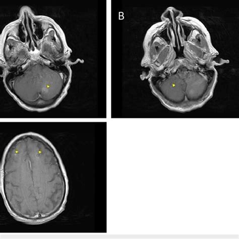 MRI Brain Axial T1 Post-Contrast A -1.4 cm L cerebellar lesion; B -3 mm... | Download Scientific ...