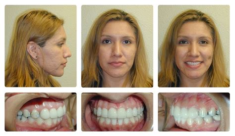 Orthodontic Before and After Photos | Brodsky Orthodontics