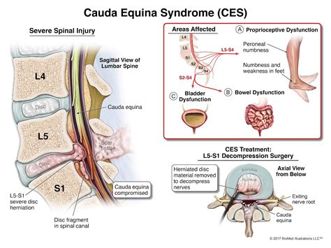 Cauda Equina Syndrome - CMG Law