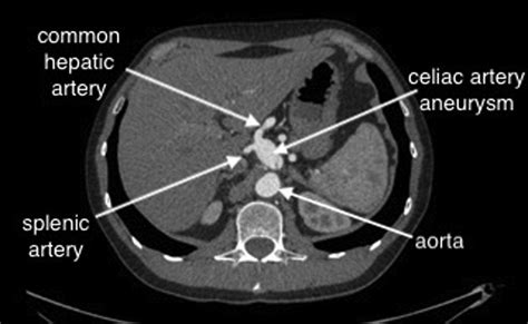 Celiac Artery