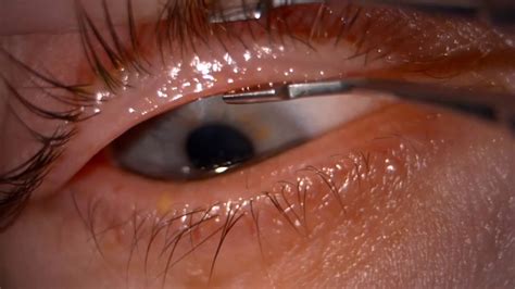 Dry and Watery Eyes Treatment That Really Works: MGD forceps procedure ...