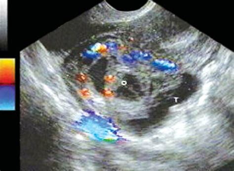 Tubo-ovarian abscess. Tubo-ovarian complex in which is it difficult to... | Download Scientific ...