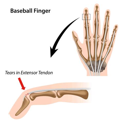 Extensor Tendon Tear - Heiden Orthopedics