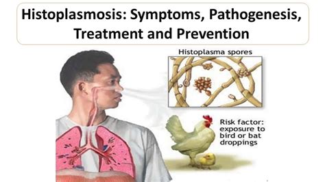 Histoplasmosis Symptoms