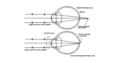 When do we consider a person to be myopic or hypermetropic? Explain ...