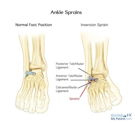 Inversion Sprain of the Ankle | Rehab My Patient