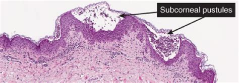 Acantholytic, Vesicular, and Pustular Disorders | Plastic Surgery Key