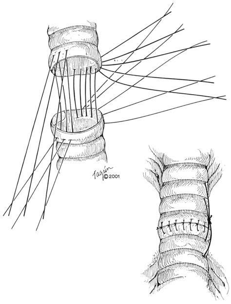 Tracheal anastomosis. | Download Scientific Diagram