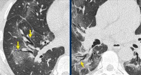 The Radiology Assistant : COVID-19