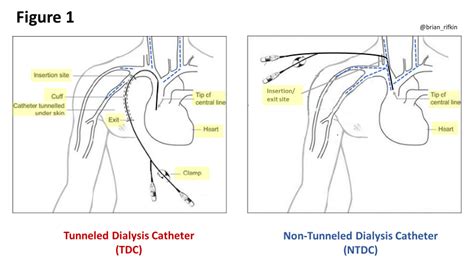 Should Tunneled Dialysis Catheters be Placed at the Bedside in Critically-Ill Patients? - Renal ...