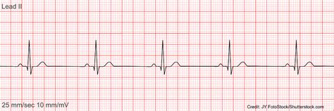 Sinus Bradycardia ECG/EKG NCLEX Quiz