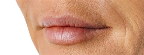 Wrinkles around Lips, Lip Wrinkles, How to get Rid of Wrinkles around Lips, Smile Lines ...