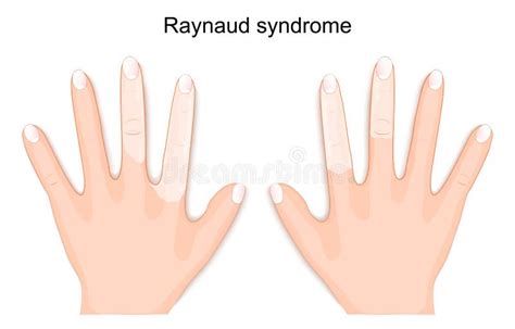 Human Hands with Symptoms of Raynaud Syndrome Stock Illustration - Illustration of circulation ...