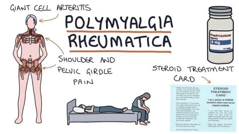 Polymyalgia Rheumatica - Natural Treatments & Home Remedies