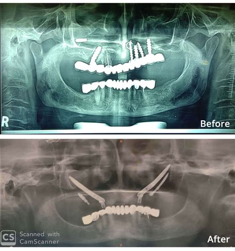 FAQs on Zygomatic Dental Implants - Royal Dental Clinics Blog