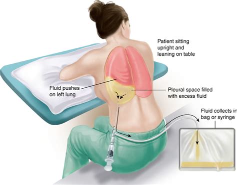 Thoracentesis indications, thoracentesis procedure, position & complications