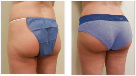 Butt injections in Boston | Butt Lift Surgery with Dermal Fillers