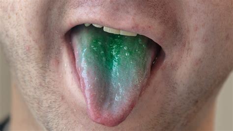 Why Is My Tongue Green? Green Tongue Causes, Symptoms, Diagnosis - American Celiac