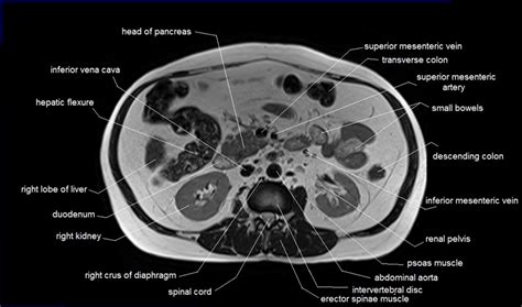 Abdomen Anatomy | MRI Abdomen Axial Anatomy | Free Cross Sectional Anatomy