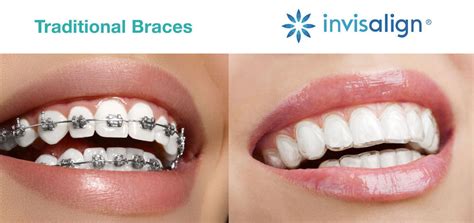 Invisalign vs Braces: Which Choice is Right for You? - Arrow Smile Dental