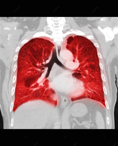 Ct Comparison Of Normal And Covid19 Infected Lungs Photo Background And Picture For Free ...