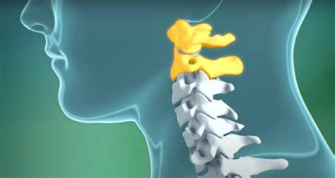 Atlantoaxial Instability: Definition - Spine Info