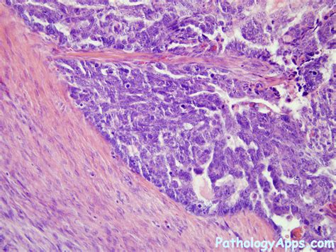 Serous Ovarian Cancer Histology - CancerWalls