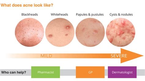 The Causes And Treatments Of Whiteheads At Home